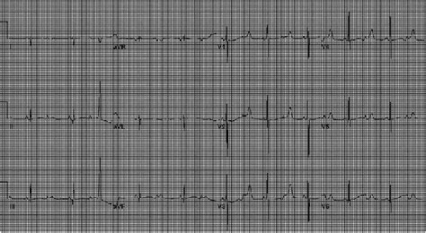 Electrocardiogram With Sinus Rhythm With A Prolonged Corrected QT
