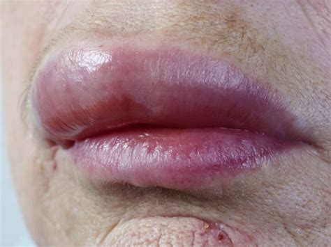 Eczema On Lips Treatments