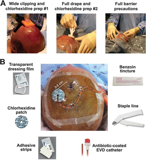 A Simple Protocol To Prevent External Ventricular Drain Infections