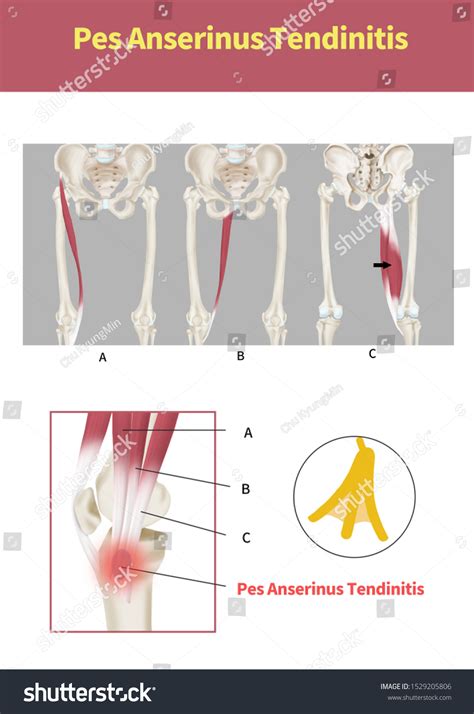 Medical Illustration Explain Pes Anserinus Tendinitis Stok Ll Strasyon Shutterstock