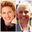 Ellen DeGeneres Plastic Surgery Photos [Before & After] - Surgery4
