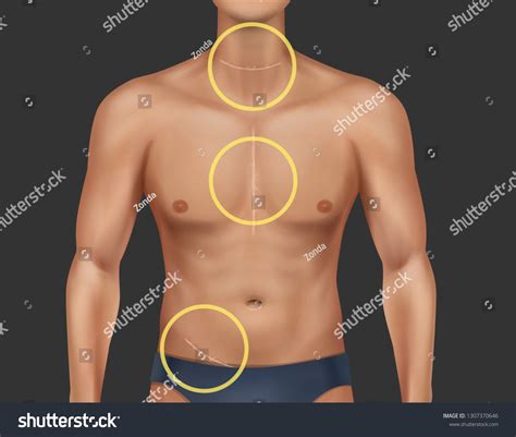 Thyroid Surgery Scar Over Royalty Free Licensable Stock Vectors