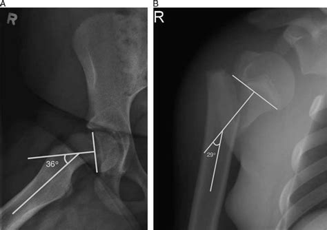 A Right Hip Radiograph In A Patient With Slipped Capital Femoral