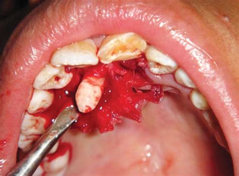 Intraoral Photograph Showing Removal Of Impacted Supernumerary Tooth