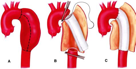 Case In Cardiac Surgery • Open Heart