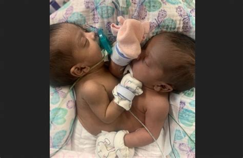 Conjoined Twins Doing Great After Incredible 11 Hour Separation Surgery