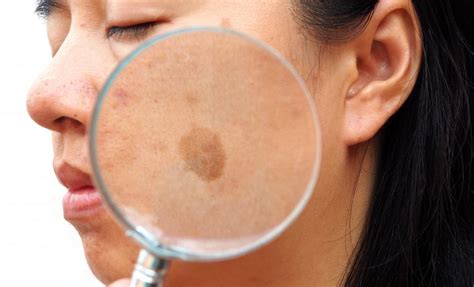 Recognizing A Seborrheic Keratosis And Why It Matters Ali Hendi Md Skin Cancer Specialists