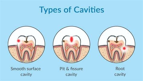 Tooth Decay Symptons Causes Treatment Nearby Dental