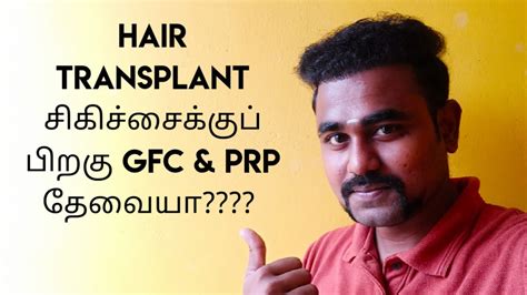 Do You Need Gfc Prp After Hair Transplant Treatment Month Hair