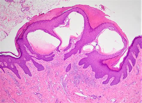 Pathology Outlines Cystic Cavernous Lymphangioma