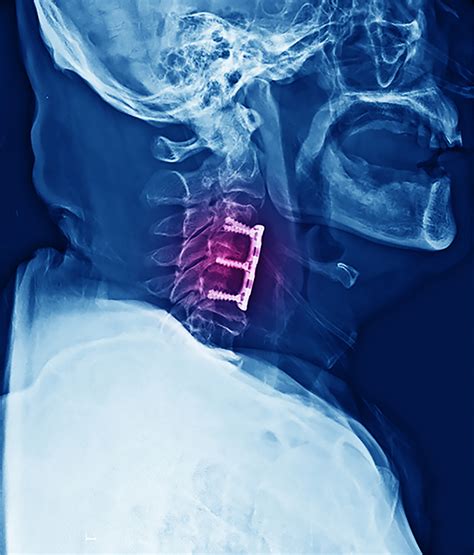 Anterior Cervical Discectomy And Fusion In Nj And Nyc