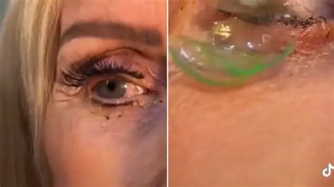 Doctor Removes 23 Contact Lenses From A Womans Eye After She Forgot To