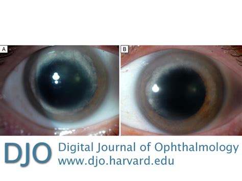 Djo Digital Journal Of Ophthalmology