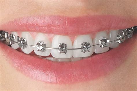 Metallic Braces Teeth And Braces Clinic Indore