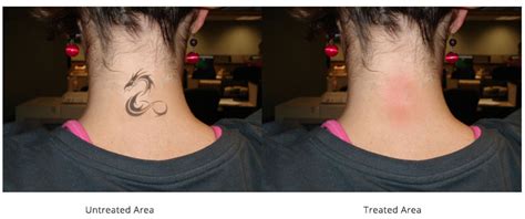 Laser Tattoo Removal Before And After