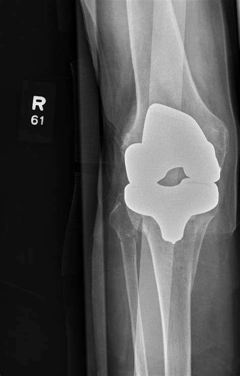 X Ray Goes Knee Deep Clinician Reviews