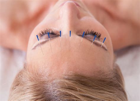 Augenakupunktur Praxis Brusdeilins