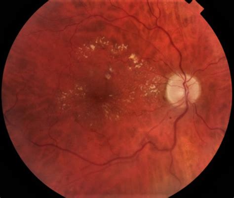 Central Retinal Vein Occlusion Retina Associates Of Greater Philadelphia