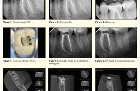 The Endodontics Renaissance And Modern Day Root Canals Dentistry Today
