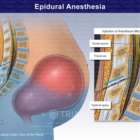 Epidural Anesthesia Trial Exhibits Inc