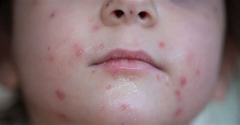 The Differences Between Coxsackievirus And Chickenpox To Get Your Kid