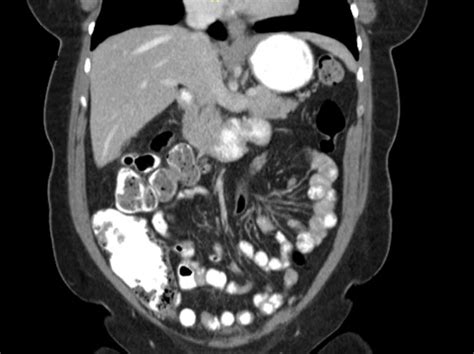 Ct Scan Of The Abdomen Showing The Absence Of The Gallbladder Within