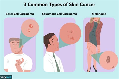 What Different Types Of Skin Cancer Is There Best Home Design Ideas