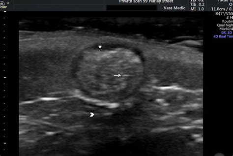 Lumps And Bumps Scan Private Ultrasound Scans London