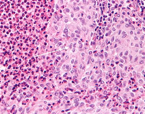 Langerhans Cell Histiocytosis Pediatrics Medbullets Step 23