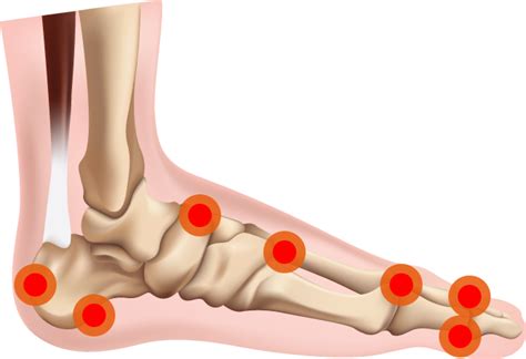 Bone Spur Diagnosis And Treatment Doctor Moore Foot And Ankle