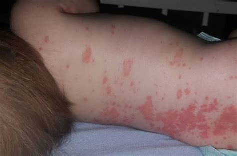 Mums Horrifying Pictures Show How Babys Meningitis Rash Spread To His