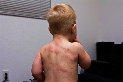 Understanding And Treating Roseola In The Early Stages Symptoms And