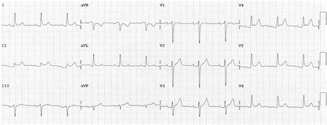 Il classico sintomo della pericardite è il dolore toracico, che ricorda, per certi. PR segment • LITFL • ECG Library Basics