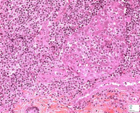 Atypical Salivary Lymphoid Hyperplasia Human Pathology