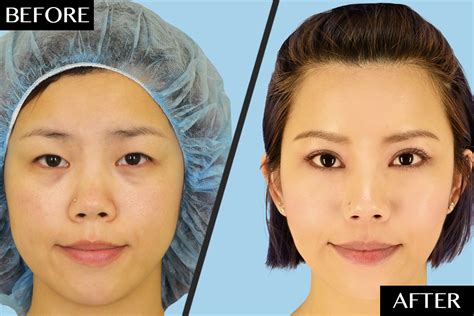 Before And After Plastic Surgery Asian