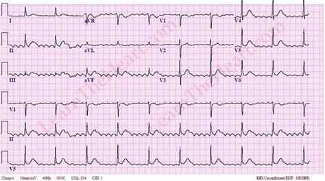 Atrial Flutter With 61 Conduction Ecg