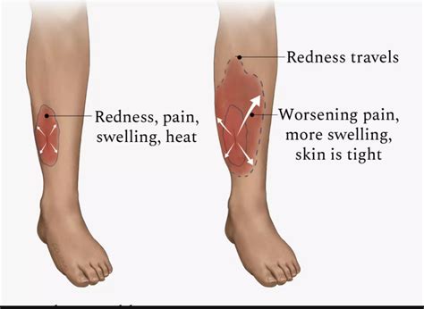 Cellulitis The Dada2 Foundation