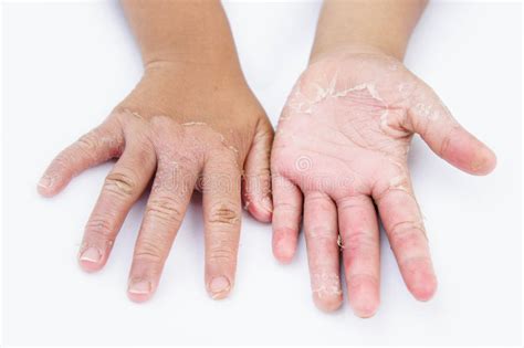 Dry Hands Peel Contact Dermatitis Fungal Infections Skin Inf Stock
