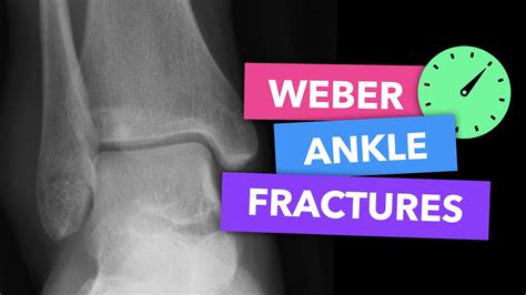 Weber Ankle Fractures Radiopaedias Emergency Radiology Course Youtube