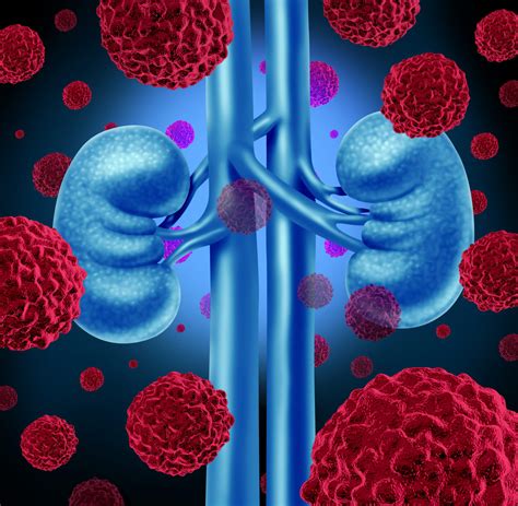Immunotherapy Drug Delays Recurrence In Kidney Cancer Patients Dana