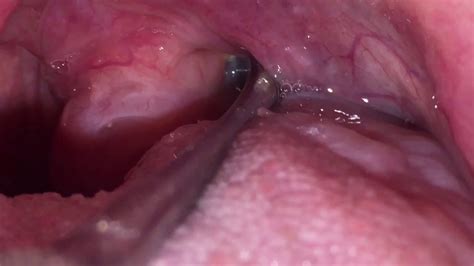 Tonsil Stone Removal19 Youtube