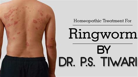 How To Treat Ringworm In Homeopathy By Dr Ps Tiwari Youtube