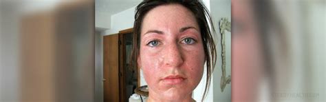 Facial Sweating And Facial Blushing General Center