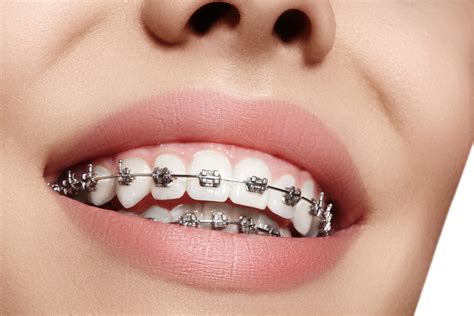 Orthodontics Thumbay Dental Hospital