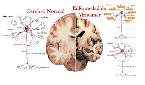 Alzheimer Cómo Empieza Alimentarte Saludable
