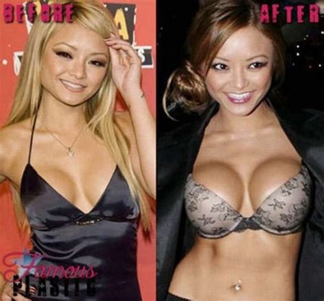 Celebrities Before And After Breast Implants