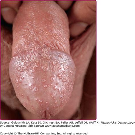 Yeast Infections Candidiasis Tinea Pityriasis Versicolor And Malassezia Pityrosporum