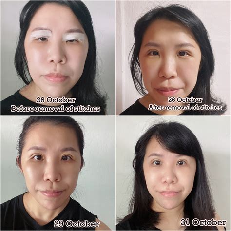 Beauty Review My Double Eyelid Surgery Review With The Clifford