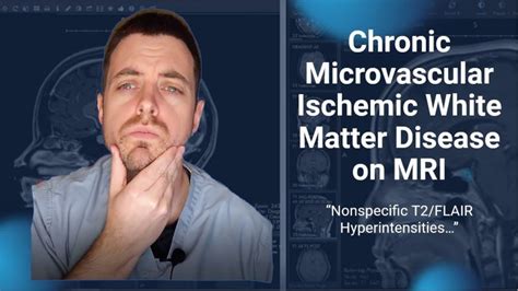 Chronic Microvascular Ischemic White Matter Disease Of The Brain On Mri
