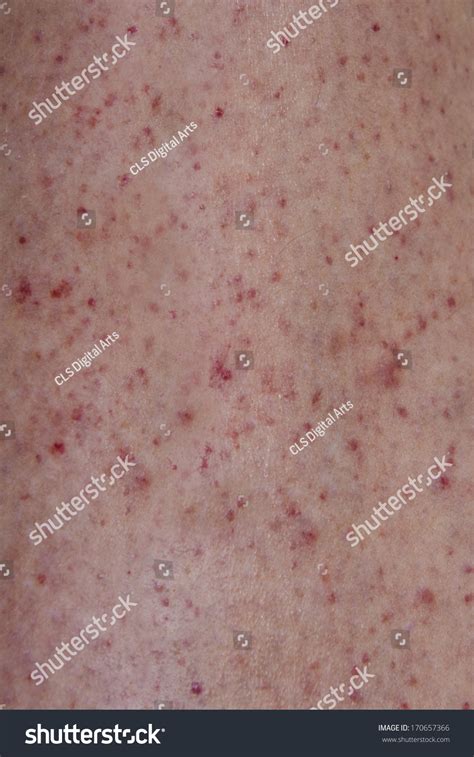 287 Hemorrhagic Rash Images Stock Photos And Vectors Shutterstock